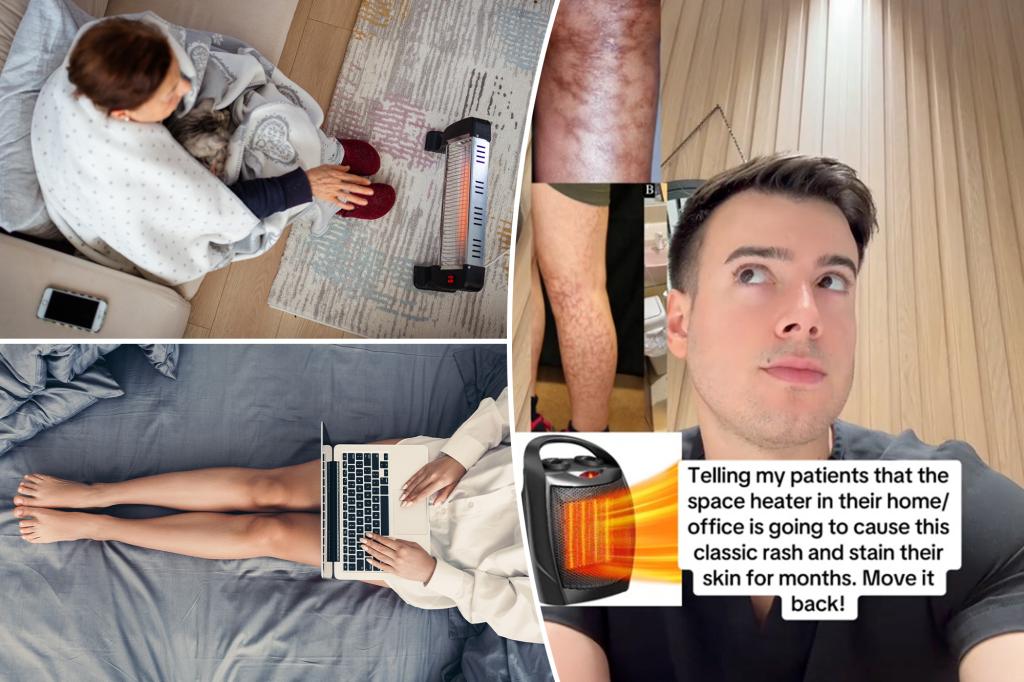 Space heater can cause erythema ab igne, doctor warns